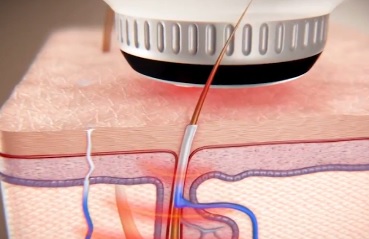 АППАРАТ-ОТ-ПОТЛИВОСТИ